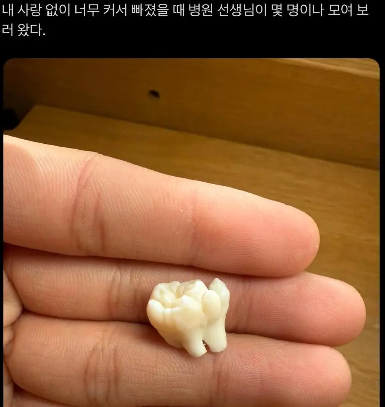 사랑니가 너무 커서 뺄 때 의사분들이 구경왔음